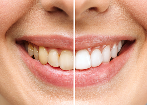 BLANQUEAMIENTO DENTAL EN GUAYAQUIL
