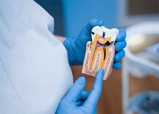 CURAR CARIES EN GUAYAQUIL