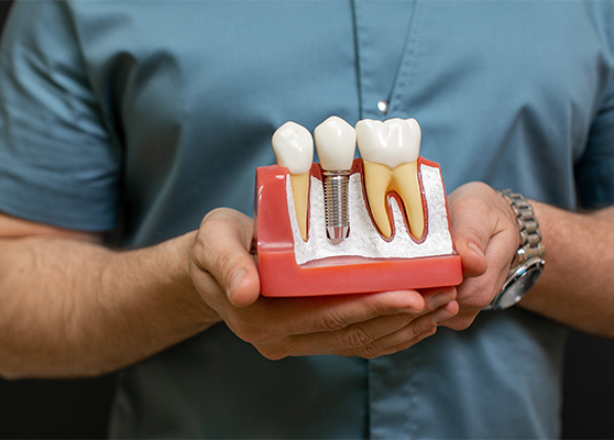 IMPLANTES DENTALES A BUEN PRECIO EN GUAYAQUIL